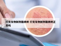 打完生物制剂胳膊疼 打完生物制剂胳膊疼正常吗