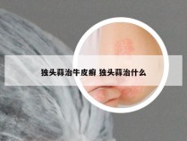 独头蒜治牛皮癣 独头蒜治什么