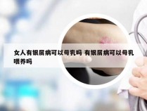 女人有银屑病可以母乳吗 有银屑病可以母乳喂养吗