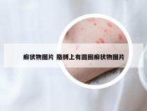 癣状物图片 胳膊上有圆圈癣状物图片