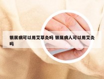 银屑病可以用艾草灸吗 银屑病人可以用艾灸吗