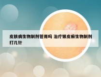 皮肤病生物制剂管用吗 治疗银皮癣生物制剂打几针