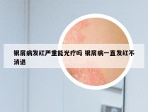 银屑病发红严重能光疗吗 银屑病一直发红不消退