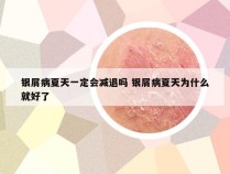 银屑病夏天一定会减退吗 银屑病夏天为什么就好了