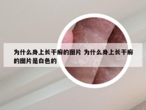 为什么身上长干癣的图片 为什么身上长干癣的图片是白色的