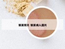 银屑照片 银屑病人图片