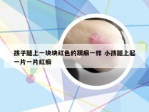 孩子腿上一块块红色的跟癣一样 小孩腿上起一片一片红癣