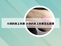 小孩的身上长癣 小孩的身上长癣怎么回事