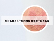 为什么身上长干癣的图片 身体有干癣怎么办