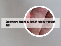 白颠风的早期图片 白颠疯病初期有什么症状图片