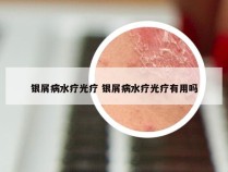 银屑病水疗光疗 银屑病水疗光疗有用吗