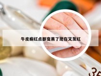 牛皮癣红点都变黑了现在又发红