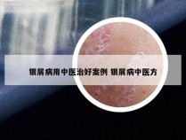 银屑病用中医治好案例 银屑病中医方