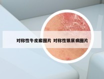 对称性牛皮廨图片 对称性银屑病图片