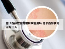 他卡西醇软膏对银屑病管用吗 他卡西醇软膏治疗什么