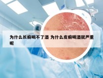 为什么长癣喝不了酒 为什么皮癣喝酒就严重呢