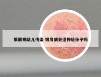 银屑病幼儿传染 银屑病会遗传给孙子吗