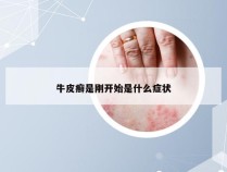 牛皮癣是刚开始是什么症状