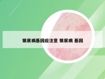 银屑病基因应注意 银屑病 基因