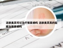 洁肤美灵可以治疗银屑病吗 洁肤美灵真的能根治银屑病吗