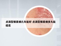 点滴型银屑病几年能好 点滴型银屑病多久能痊愈