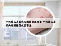 小男孩头上长头皮癣是怎么回事 小男孩头上长头皮癣是怎么回事儿