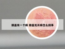 膝盖有一个癣 膝盖处长癣怎么回事