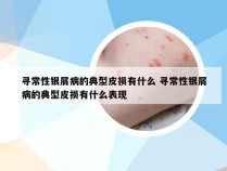 寻常性银屑病的典型皮损有什么 寻常性银屑病的典型皮损有什么表现