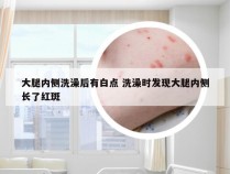 大腿内侧洗澡后有白点 洗澡时发现大腿内侧长了红斑