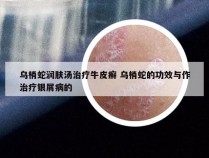 乌梢蛇润肤汤治疗牛皮癣 乌梢蛇的功效与作治疗银屑病的