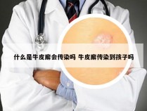 什么是牛皮廨会传染吗 牛皮廨传染到孩子吗