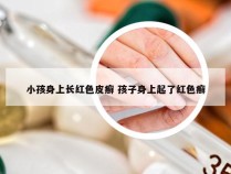 小孩身上长红色皮癣 孩子身上起了红色癣