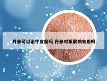 丹参可以治牛皮廨吗 丹参对银屑病有用吗