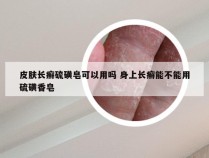 皮肤长癣硫磺皂可以用吗 身上长癣能不能用硫磺香皂