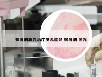 银屑病激光治疗多久能好 银屑病 激光