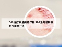 308治疗银屑病的作用 308治疗银屑病的作用是什么