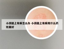 小孩腿上有癣怎么办 小孩腿上有癣用什么药效果好