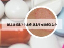 腿上突然出了牛皮癣 腿上牛皮肤癣怎么办