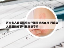 河南省人民民医院治疗银屑病怎么样 河南省人民医院皮肤科银屑病专家