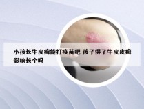 小孩长牛皮癣能打疫苗吧 孩子得了牛皮皮癣影响长个吗