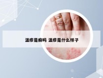 温疹是癣吗 温疹是什么样子