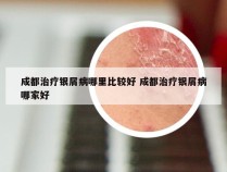 成都治疗银屑病哪里比较好 成都治疗银屑病哪家好