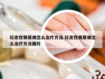 红皮性银屑病怎么治疗方法 红皮性银屑病怎么治疗方法图片