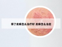 得了皮癣怎么治疗好 皮癣怎么治愈