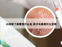 小孩得了癣要用什么治 孩子长癣用什么管用