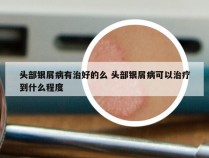 头部银屑病有治好的么 头部银屑病可以治疗到什么程度