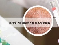 男仕头上长蒲癣怎么办 男人头皮长癣