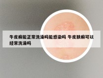 牛皮癣能正常洗澡吗能感染吗 牛皮肤癣可以经常洗澡吗