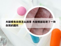 大腿根有白斑怎么回事 大腿根部出现了一块白斑的图片