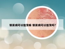 银屑病可以植发嘛 银屑病可以植发吗?